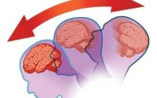 Первые и отсроченные симптомы и признаки при сотрясении мозга