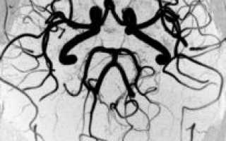 Аплазия левой задней соединительной артерии