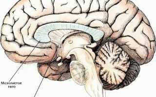 Агенезия мозолистого тела: причины, лечение и последствия