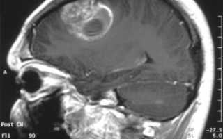 Лимфома головного мозга: причины, симптомы, лечение и прогноз