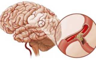 Спазм сосудов головного мозга: причины, симптомы и лечение