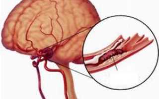 Ангиоэнцефалопатия — опасное сосудистое заболевание головного мозга