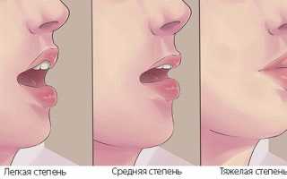 Тризм — болезненный спазм жевательных мышц челюсти