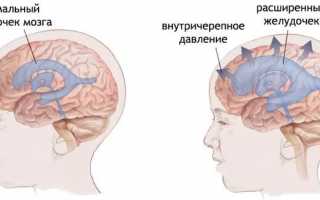 Как болит голова при опухоли головного мозга