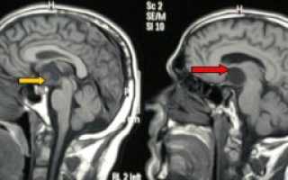 Краниофарингиома головного мозга: удаление и последствия