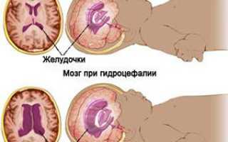 Анатомия цистерн головного мозга