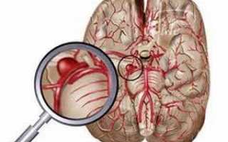 Что такое аневризма сосудов головного мозга и каковы последствия ее разрыва