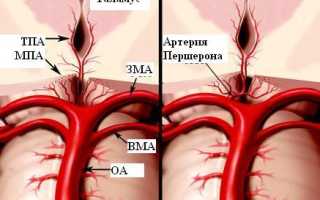 Фетальный тип строения задней мозговой артерии