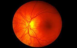 Ангиопатия сосудов сетчатки глаза что это такое