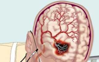 Причины, симптомы и лечение вазоспазма сосудов головного мозга