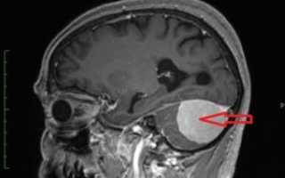 Киста шишковидной железы головного мозга: симптомы, лечение и последствия