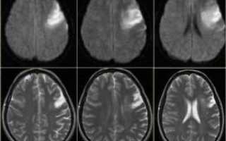 Чем чаще всего вызвана ишемия сосудов головного мозга — лечение и последствия ишемической болезни
