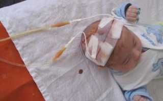 Вентрикулит — перивентрикулярный гнойный энцефалит у новорожденных