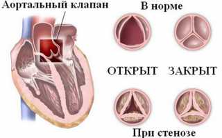 Аортальный клапанный стеноз с недостаточностью
