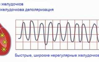 Фибрилляция желудочков при инфаркте миокарда