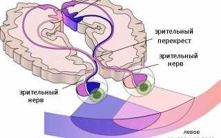 Гемианопсия, как следствие поражения зрительных нервов и структур головного мозга