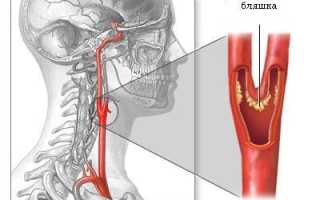 Каротидная эндартерэктомия послеоперационный период профилактика и лечение
