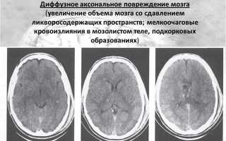 Диффузное аксональное повреждение головного мозга: симптомы, последствия, прогноз