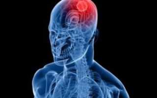 Причины и лечение менингиомы головного мозга — прогноз и последствия после удаления опухоли