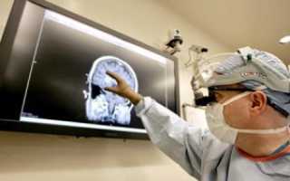 Что такое астроцитома головного мозга —  симптомы, лечение и прогноз жизни