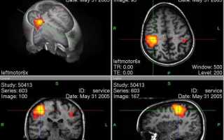 Функциональная магнитно-резонансная томография — действенный метод исследования головного мозга