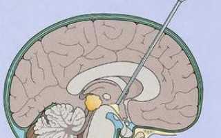 Киста прозрачной перегородки головного мозга: симптомы, лечение, последствия