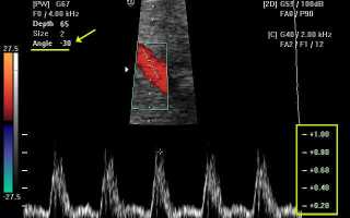 Сосудистая допплерография что это
