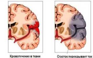 Симптомы, лечение и последствия инсульта правой стороны мозга