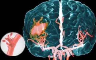 Причины, симптомы и последствия кровоизлияния в мозг