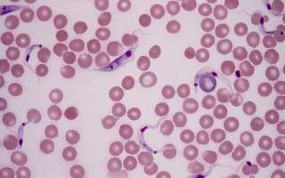 Атипичные мононуклеары в крови у ребенка норма