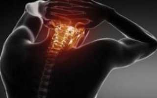 Шейная мигрень — болезненная головная боль в области затылка