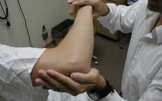 Как долго восстанавливается рука после инсульта
