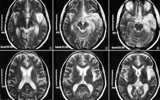 Церебральная энцефалопатия головного мозга